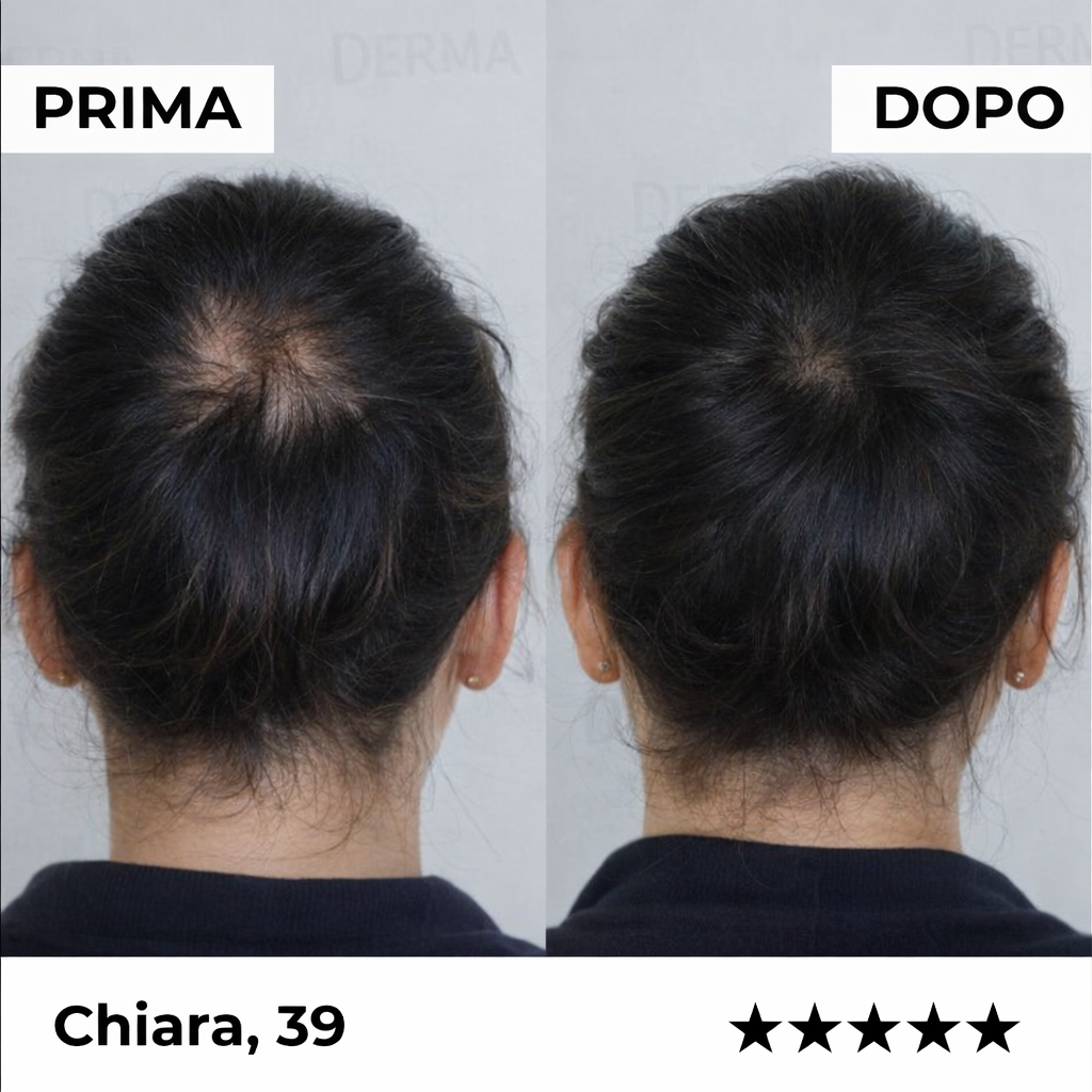 Sistema de microinfusión Firmelià® para el recrecimiento del cabello en mujeres