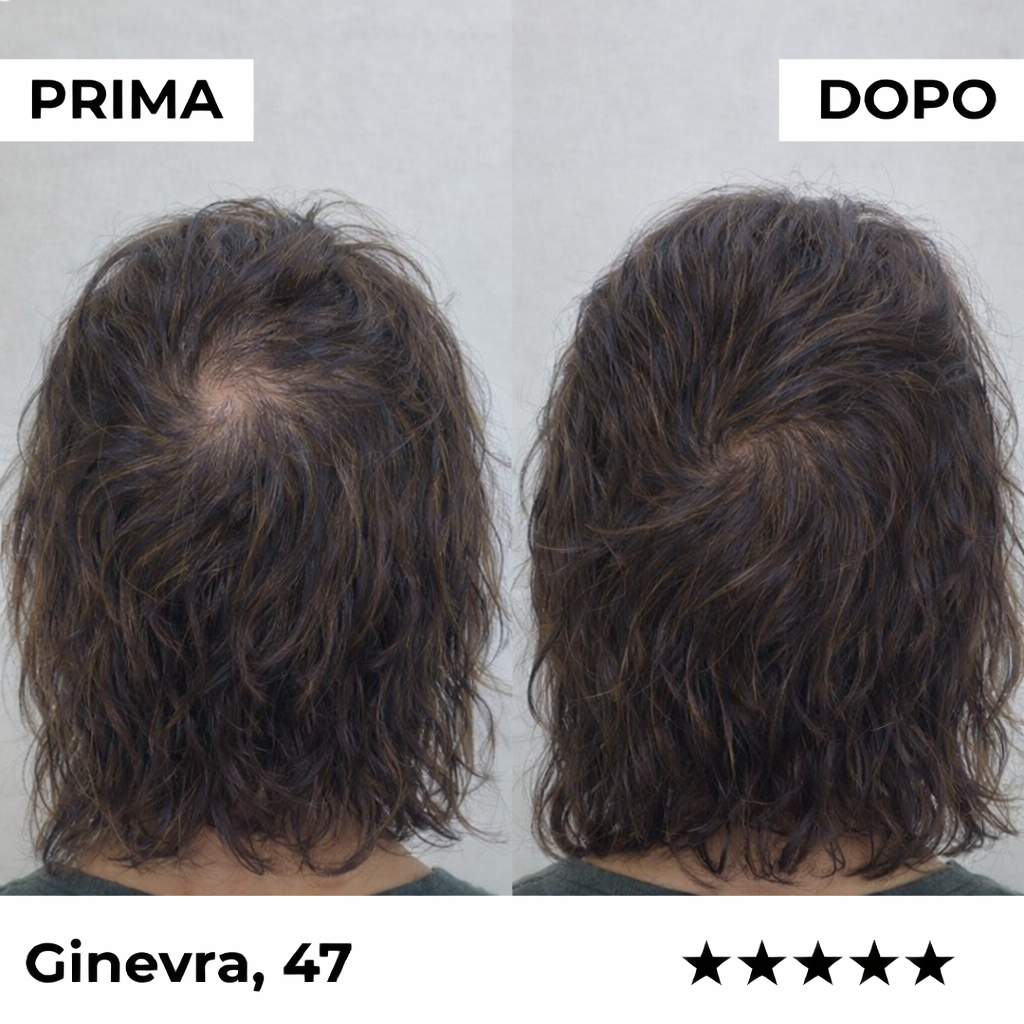 Sistema de microinfusión Firmelià® para el recrecimiento del cabello en mujeres