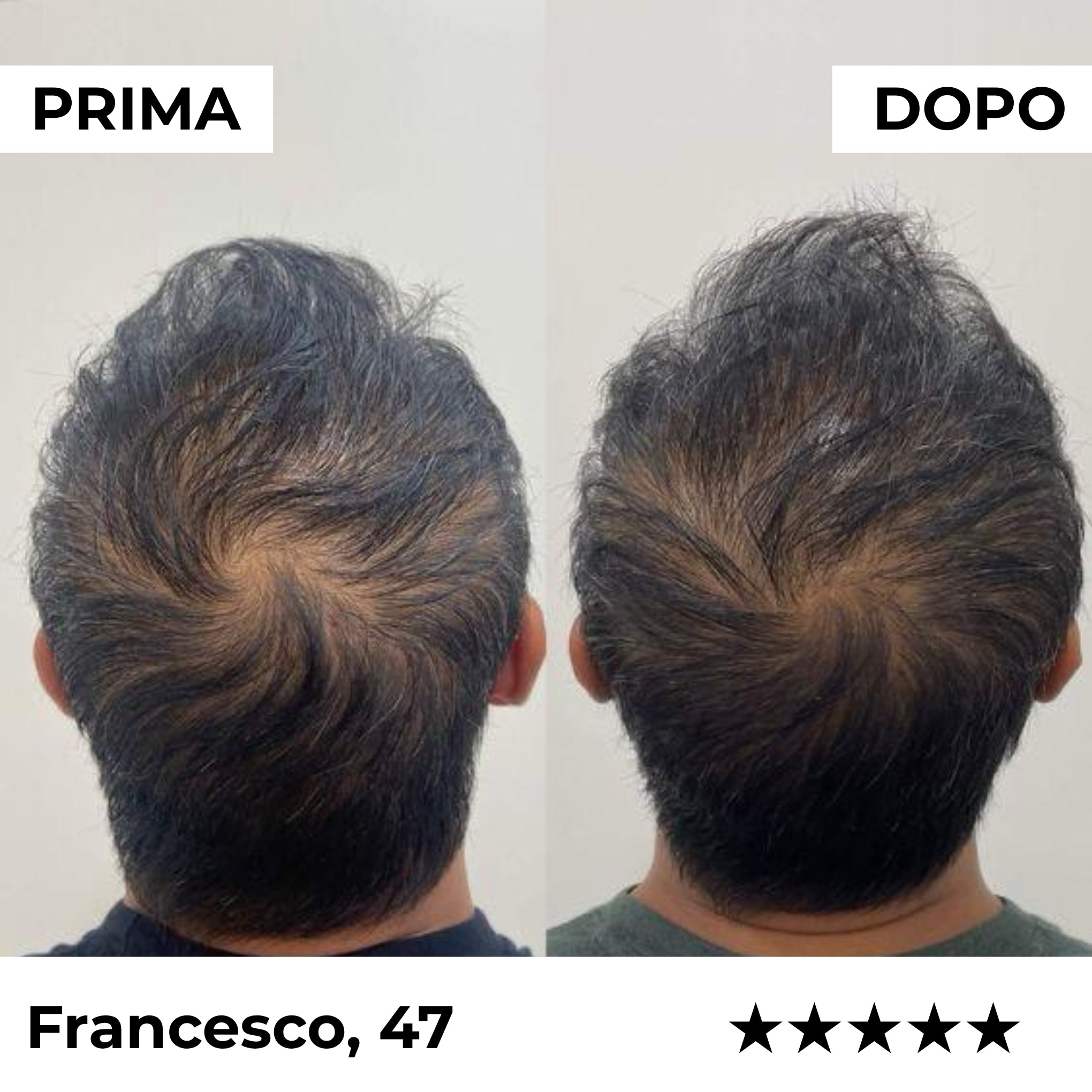 Sistema de Microinfusión Capilar Firmelià PRO®