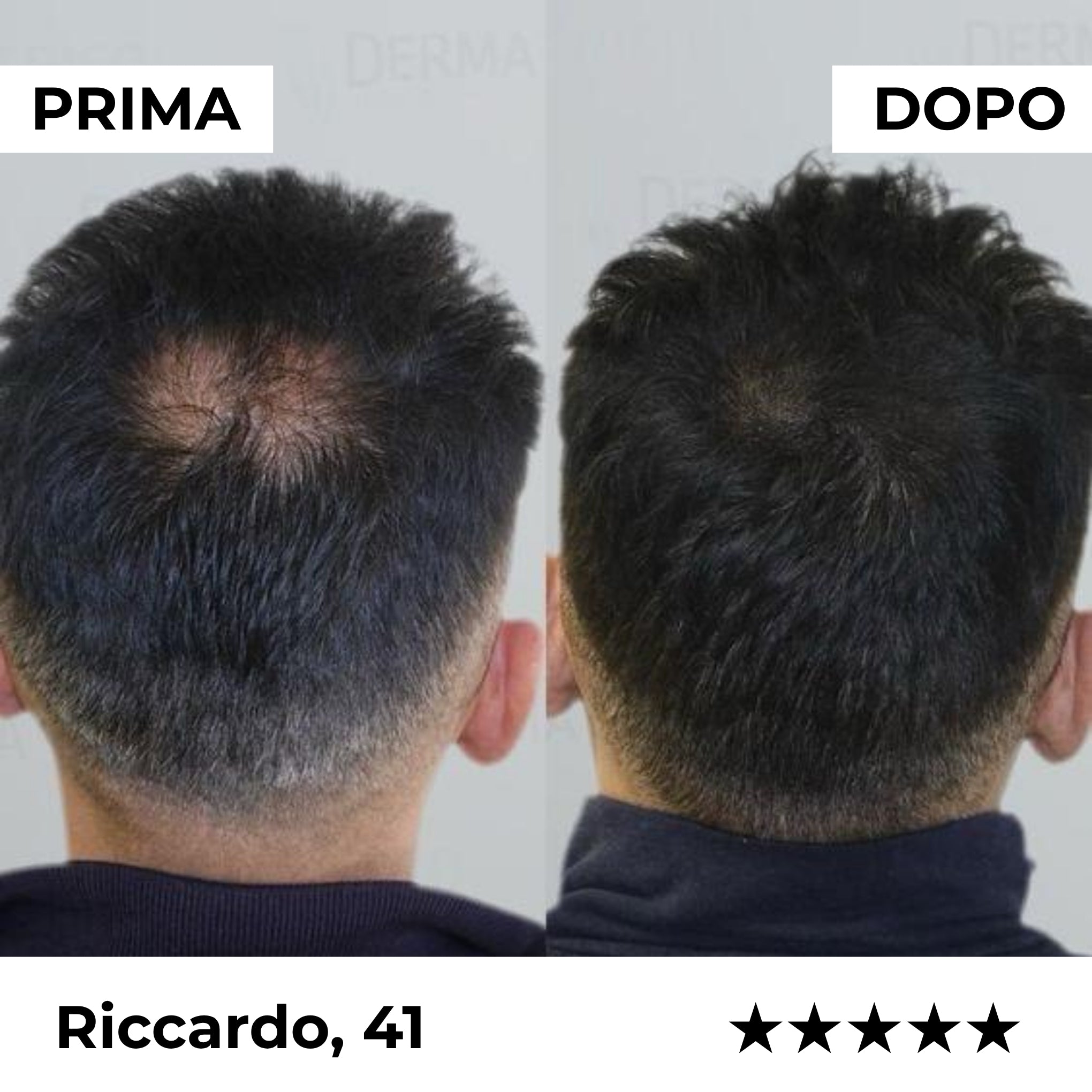 Sistema de Microinfusión Capilar Firmelià PRO®